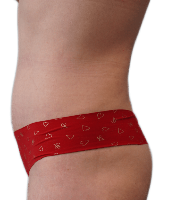 After Image: Tummy Tuck - left-side