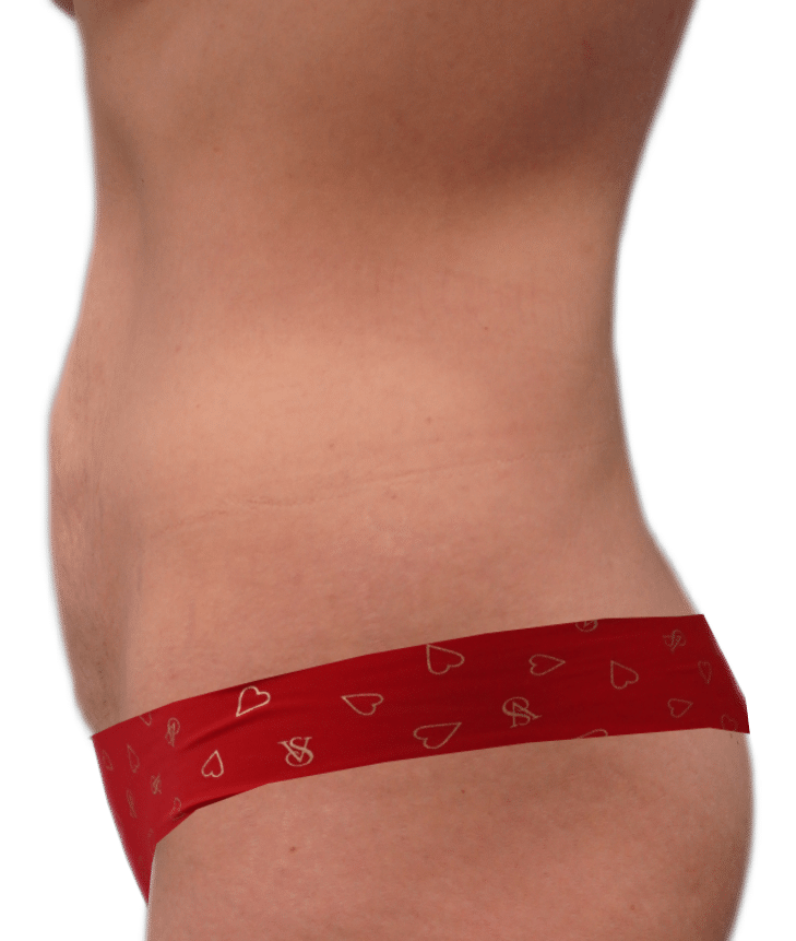 Before Image: Tummy Tuck - left-side