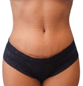 After Image: Tummy Tuck