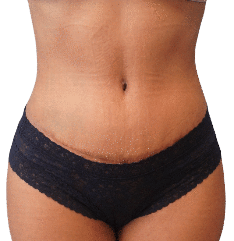 After Image: Tummy Tuck - front