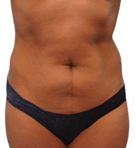 Before Image: Tummy Tuck