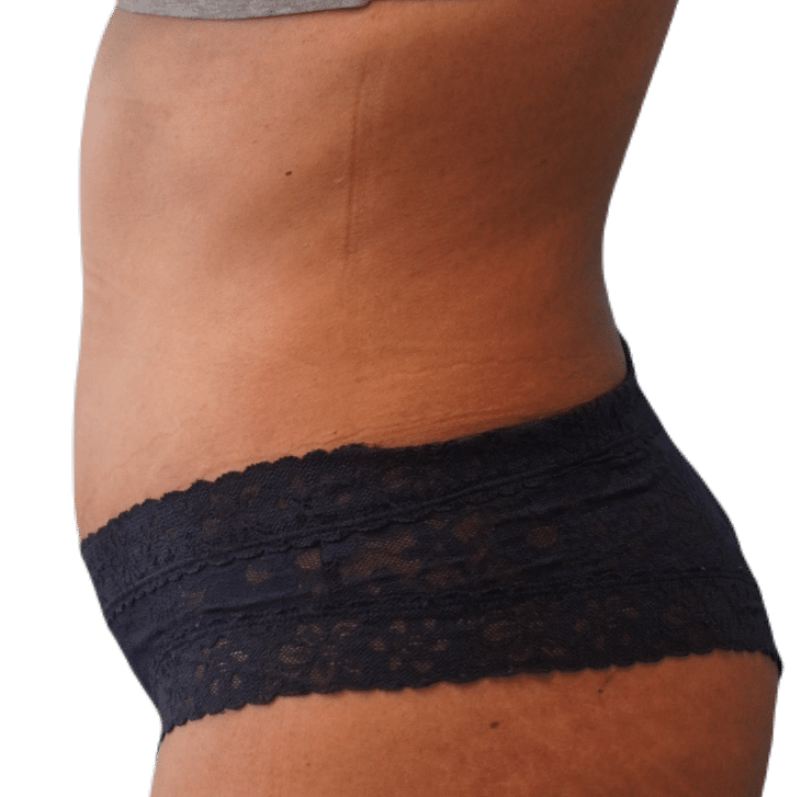 After Image: Tummy Tuck - left-side