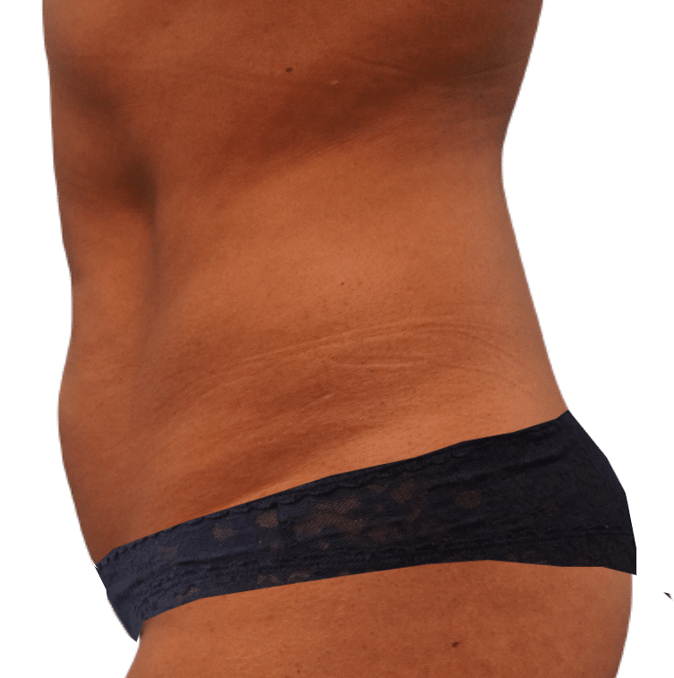 Before Image: Tummy Tuck - left-side