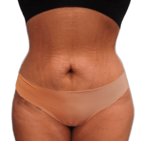 After Image: Tummy Tuck Mini with BBL