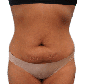 Before Image: Tummy Tuck Mini with BBL