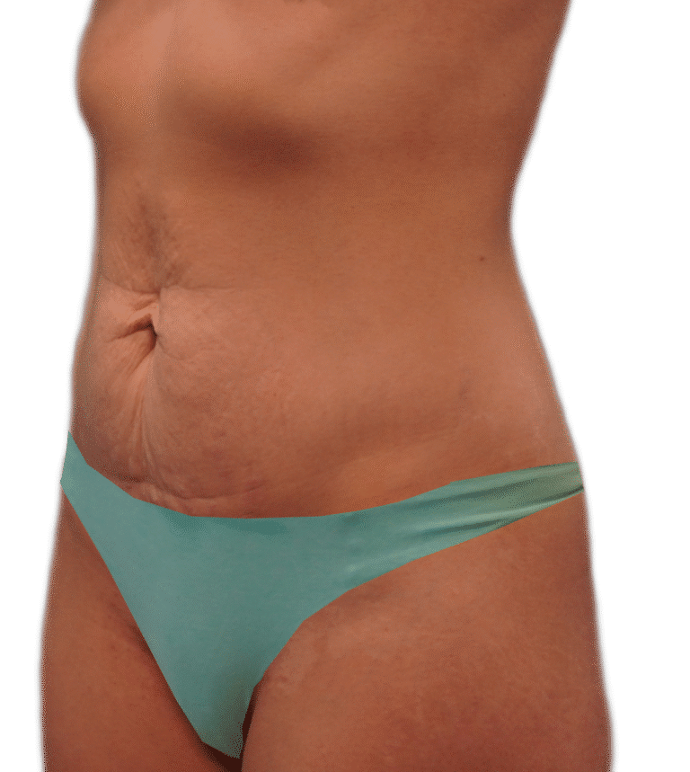 Before Image: Tummy Tuck Skinny -