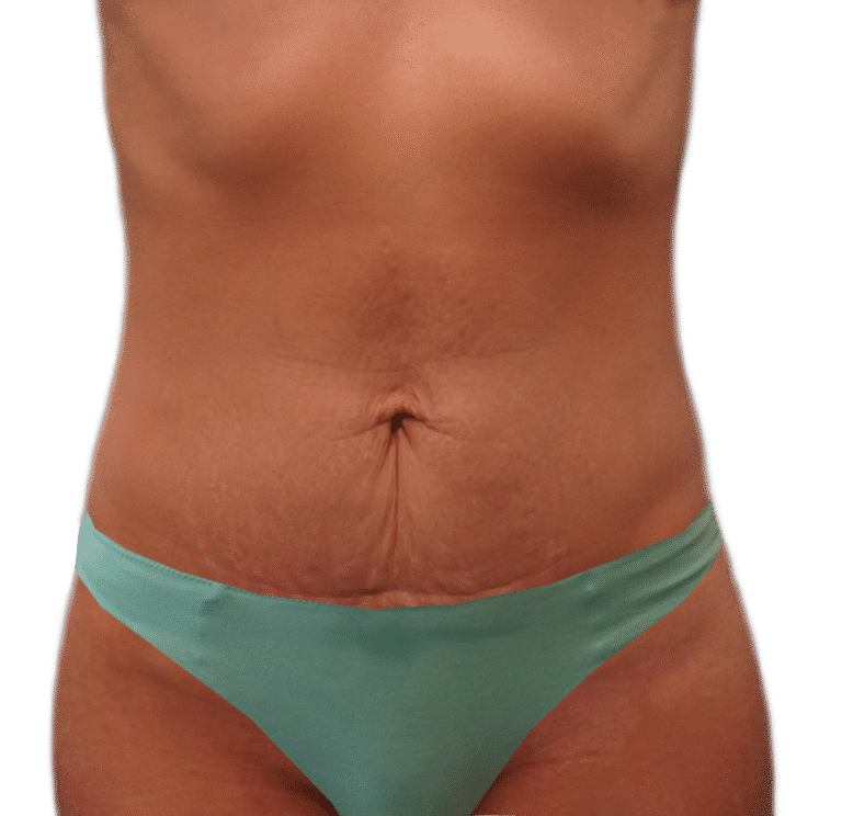 Before Image: Tummy Tuck Skinny - front