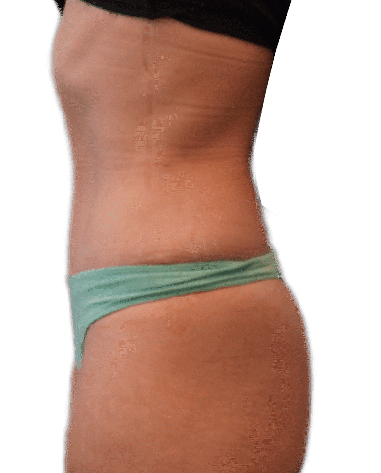 After Image: Tummy Tuck Skinny -