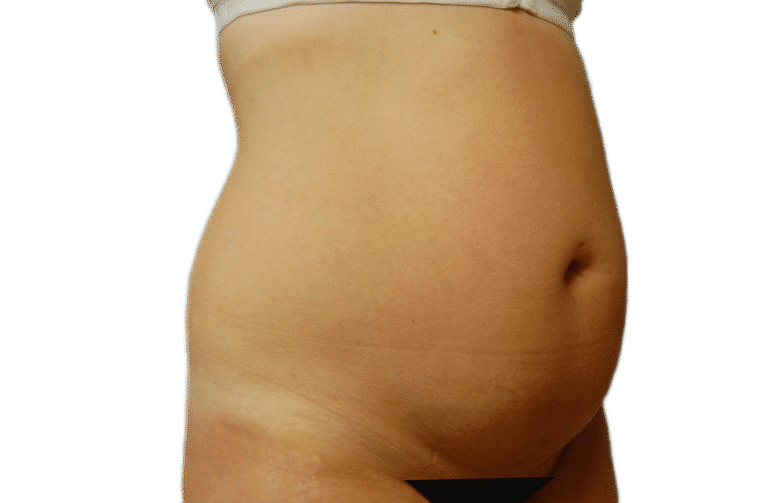 Before Image: Tummy Tuck - right-front-oblique