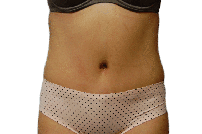 After Image: Tummy Tuck - front