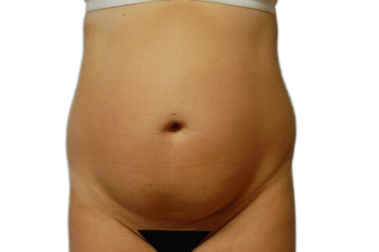 Before Image: Tummy Tuck - front
