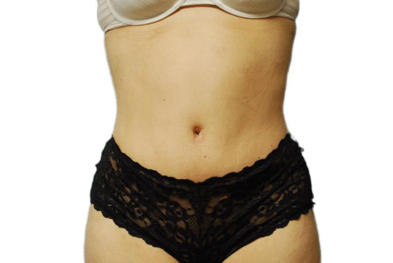 After Image: Tummy Tuck - front