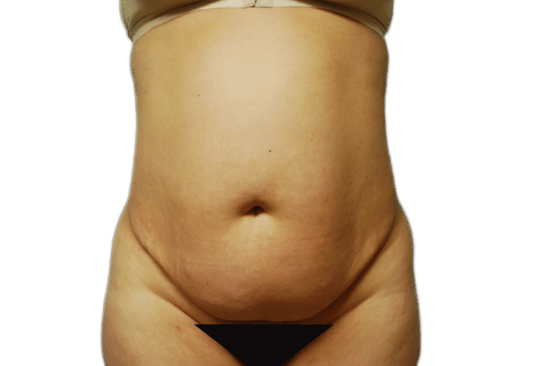 Before Image: Tummy Tuck - front