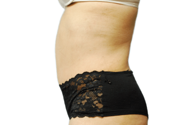 After Image: Tummy Tuck - left-side