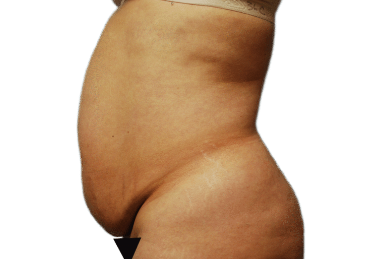 Before Image: Tummy Tuck - left-side