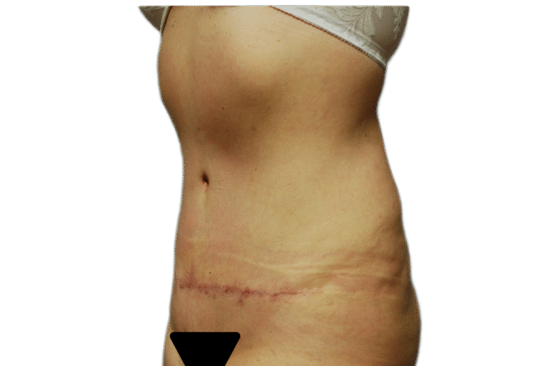 After Image: Tummy Tuck - right-front-oblique