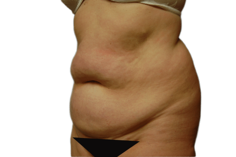 Before Image: Tummy Tuck - right-front-oblique