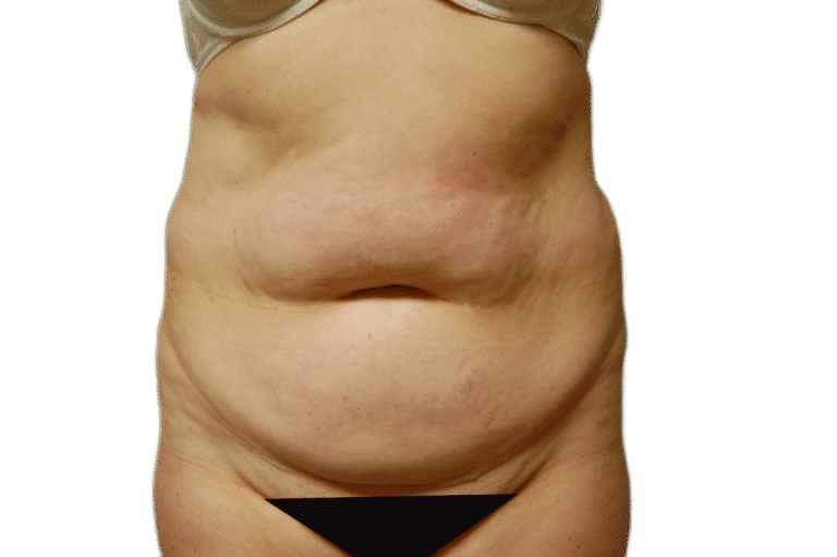 Before Image: Tummy Tuck - front
