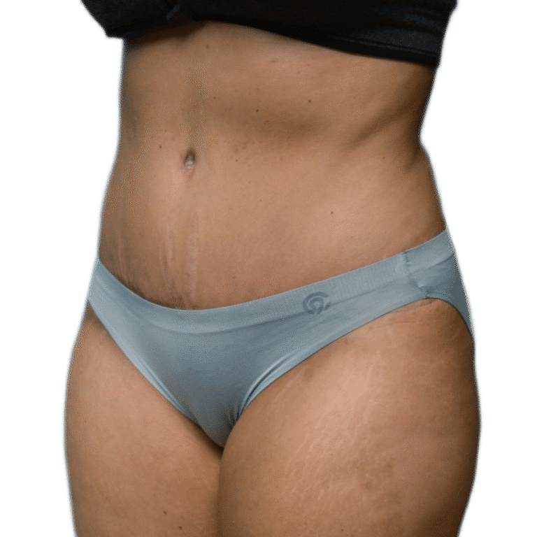 After Image: Tummy Tuck - left-front-oblique