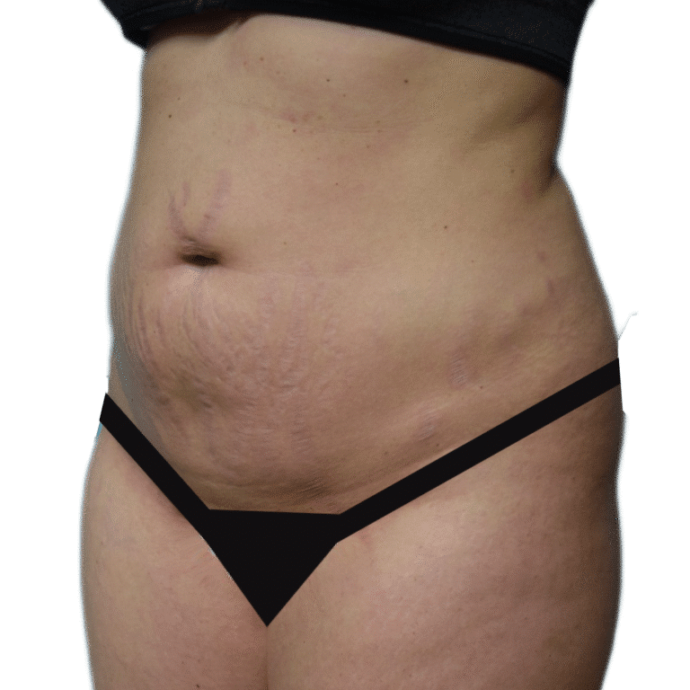Before Image: Tummy Tuck - left-front-oblique