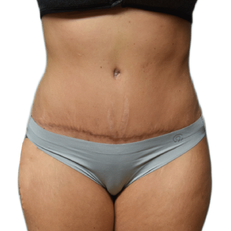 After Image: Tummy Tuck - front