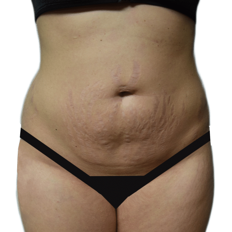 Before Image: Tummy Tuck - front