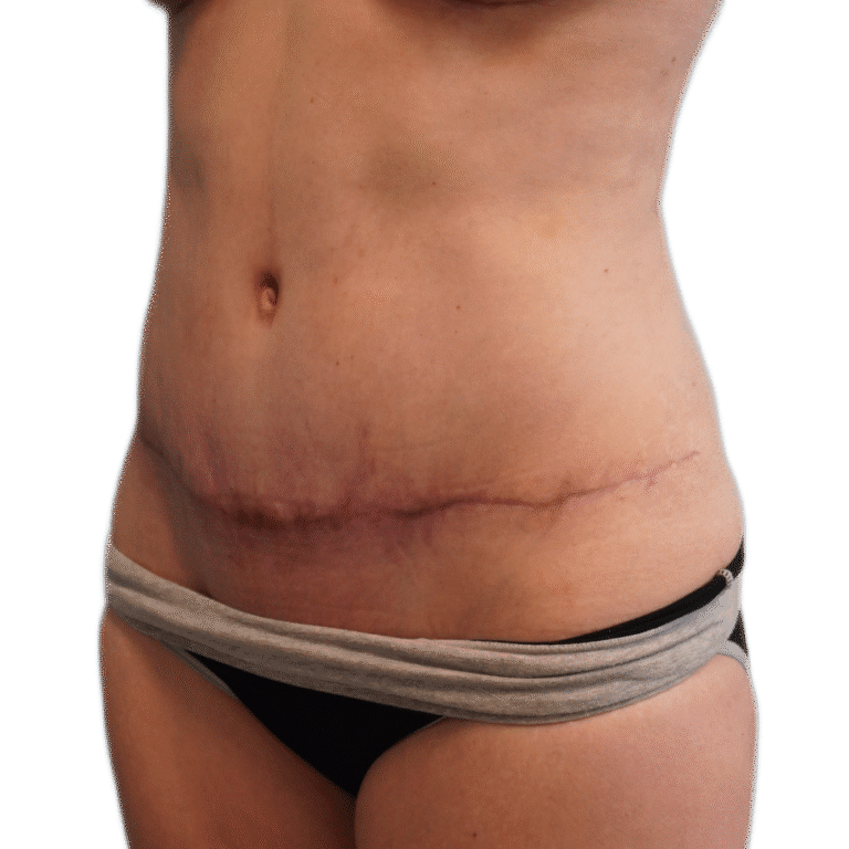 After Image: Tummy Tuck - left-back-oblique
