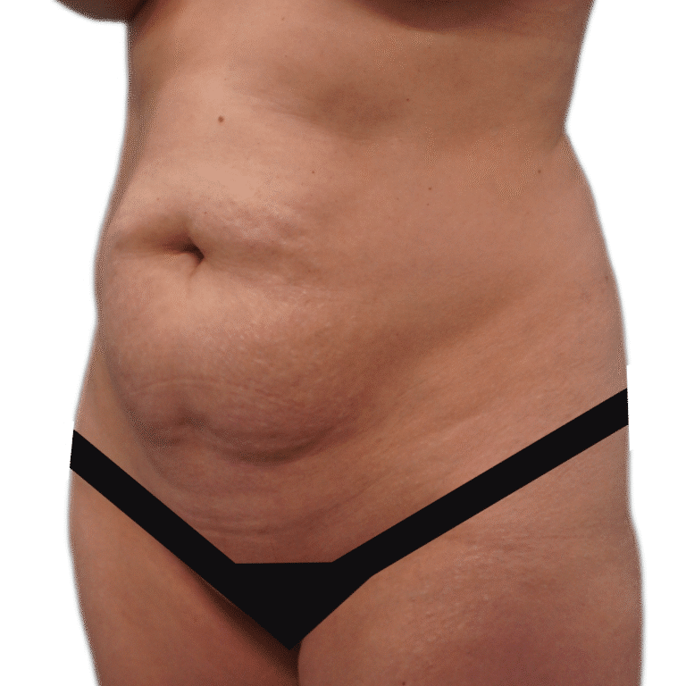 Before Image: Tummy Tuck - left-back-oblique