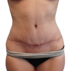 After Image: Tummy Tuck