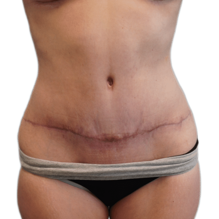 After Image: Tummy Tuck - front