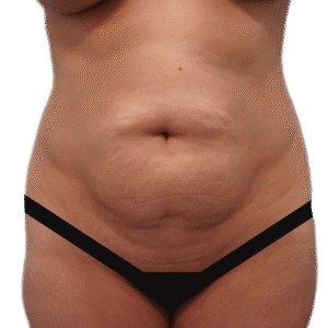 Before Image: Tummy Tuck