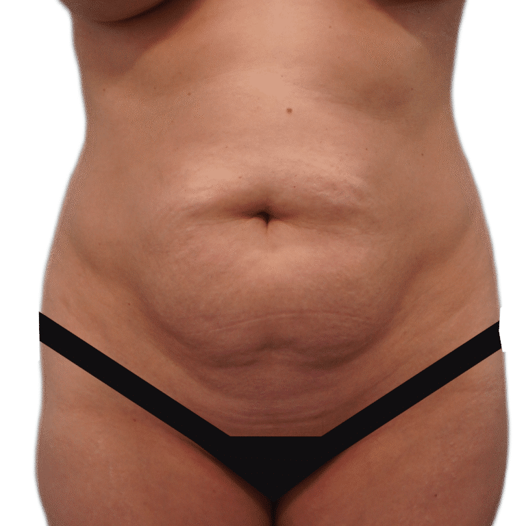 Before Image: Tummy Tuck - front