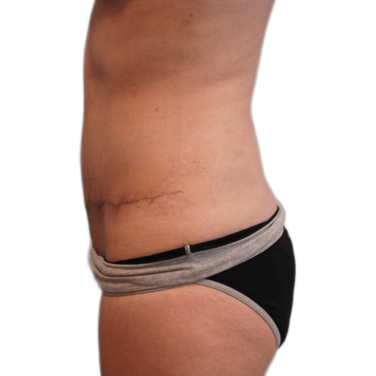 After Image: Tummy Tuck - left-side