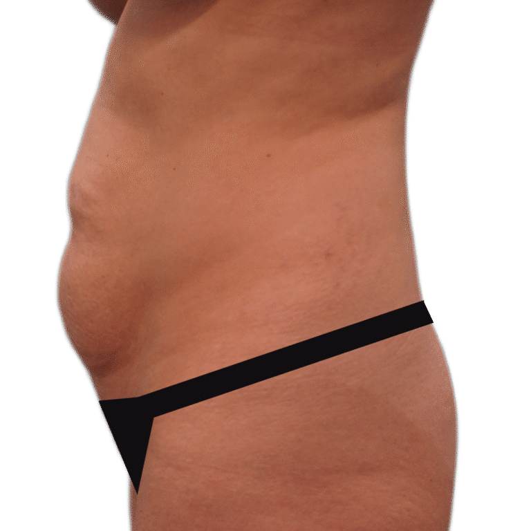 Before Image: Tummy Tuck - left-side