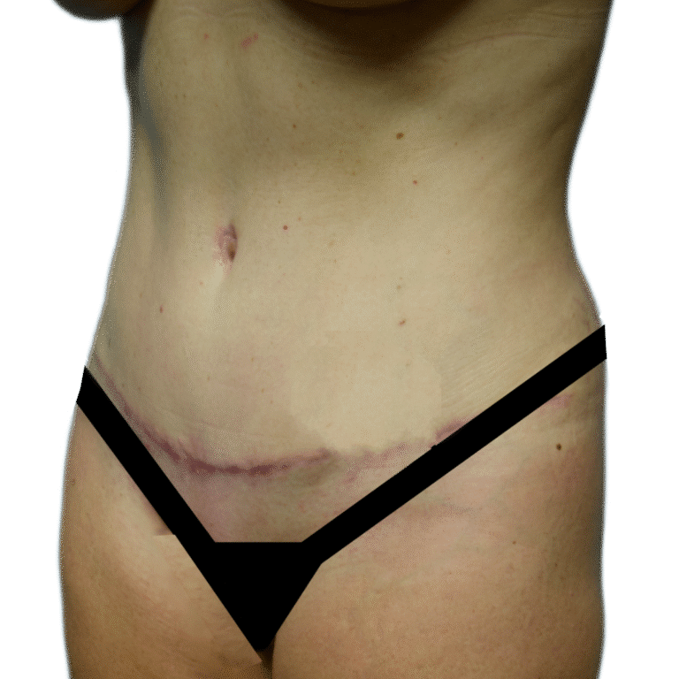 After Image: Tummy Tuck - left-front-oblique