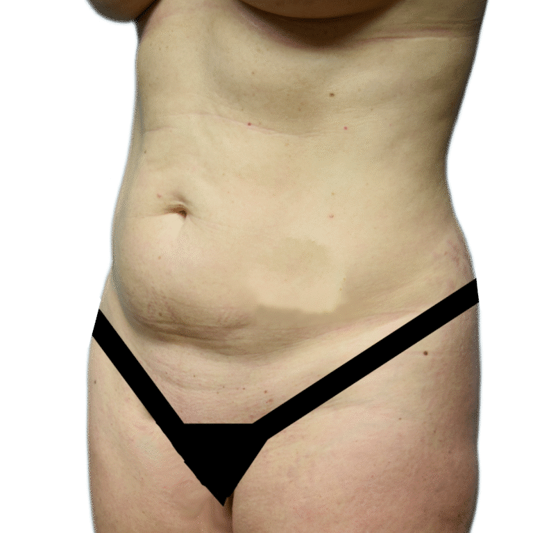 Before Image: Tummy Tuck - left-front-oblique