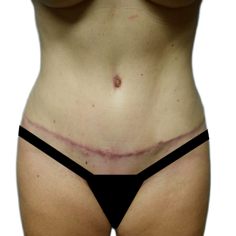 After Image: Tummy Tuck - front