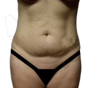 Before Image: Tummy Tuck
