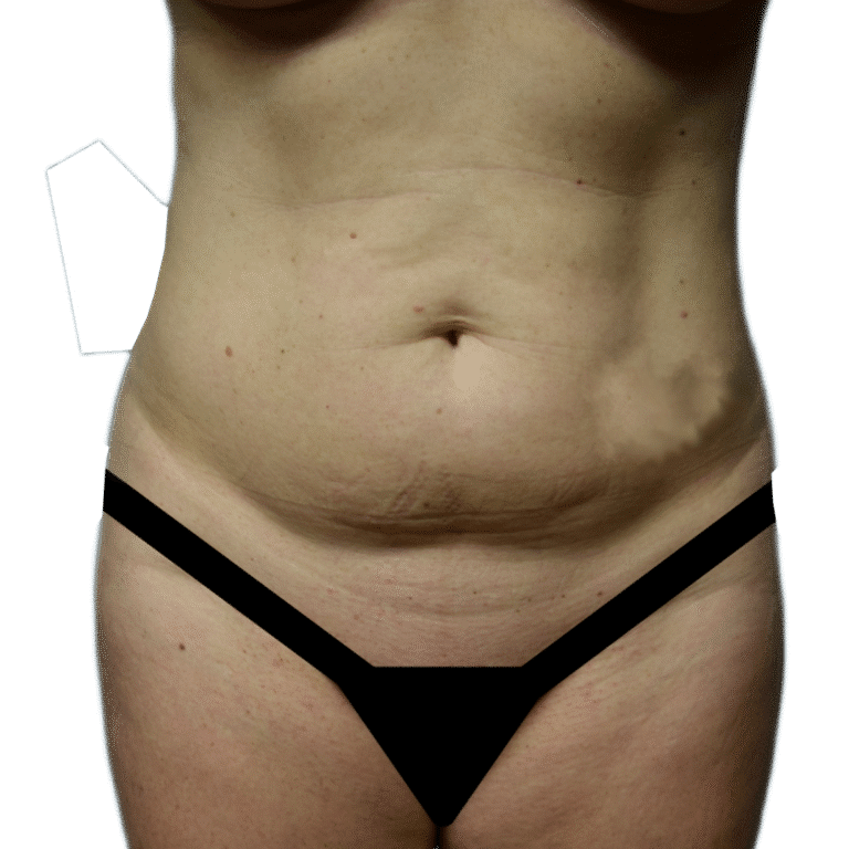 Before Image: Tummy Tuck - front