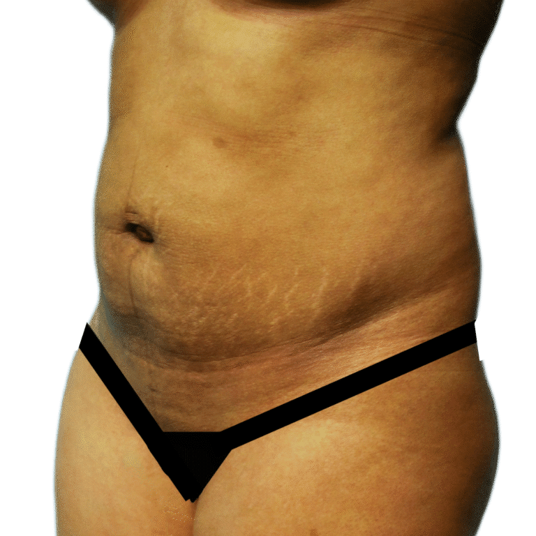 Before Image: Tummy Tuck - left-front-oblique