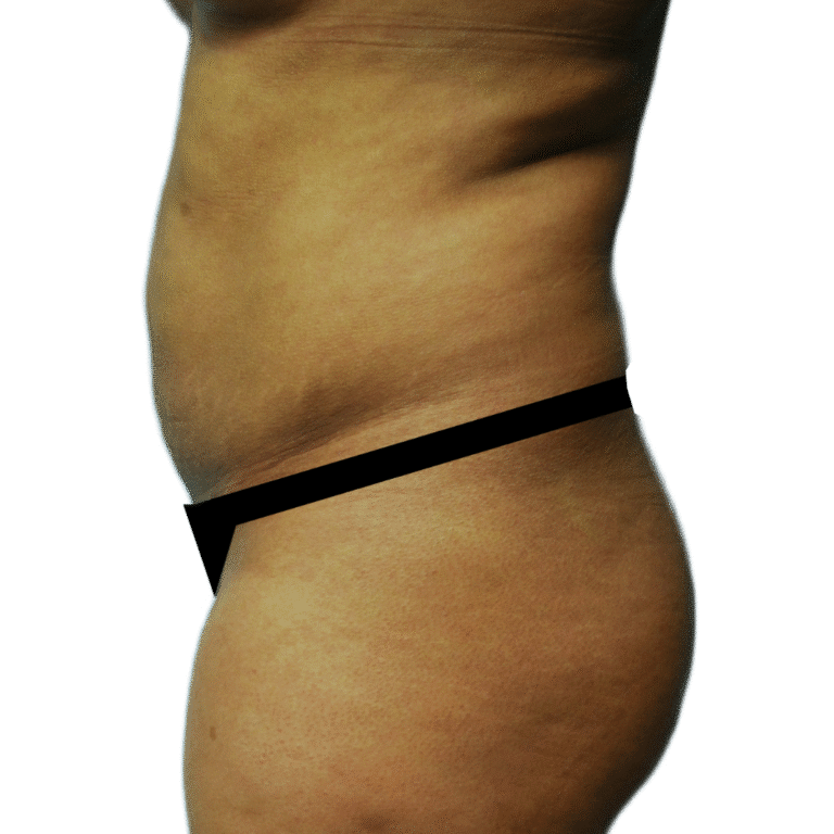 Before Image: Tummy Tuck - left-side