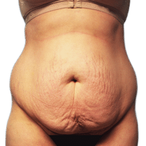 Before Image: Tummy Tuck