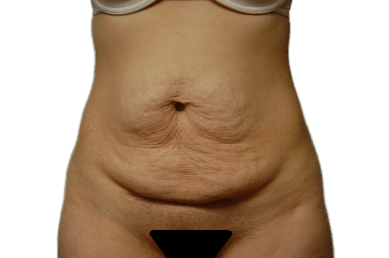 Before Image: Tummy Tuck - front