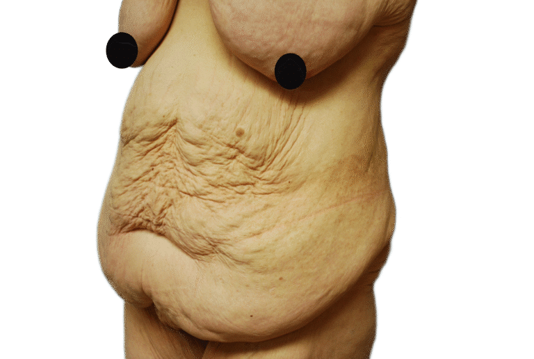 Before Image: Tummy Tuck - right-front-oblique