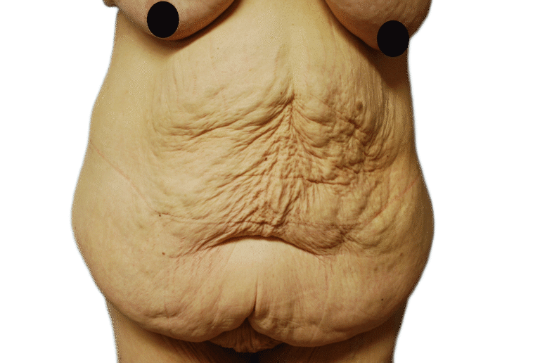 Before Image: Tummy Tuck - front