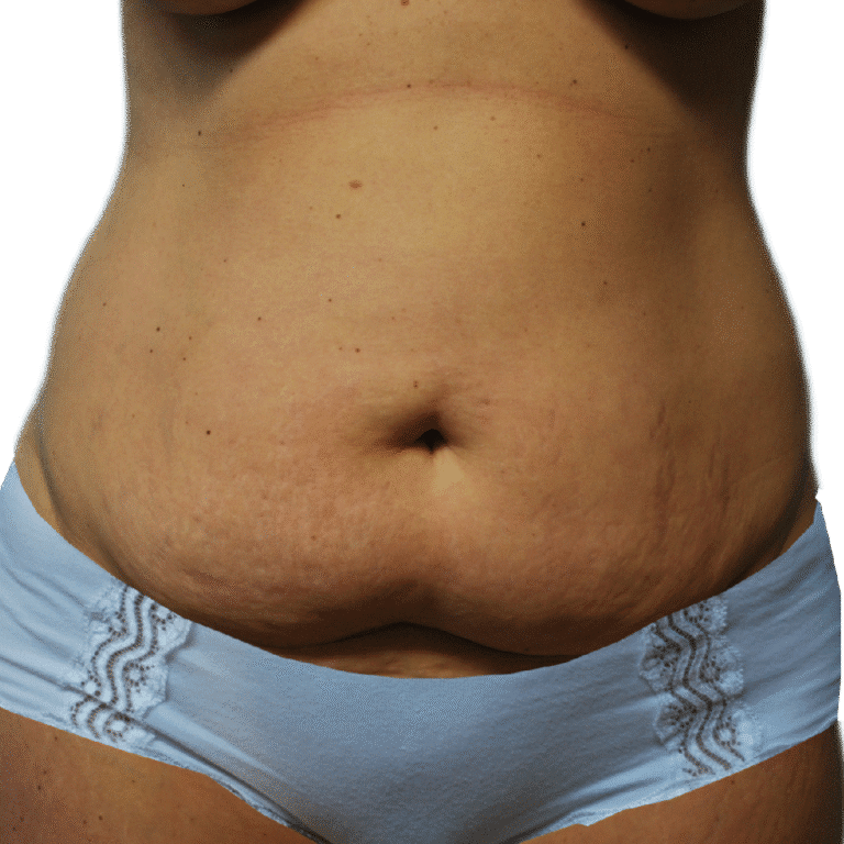 Before Image: Tummy Tuck - front