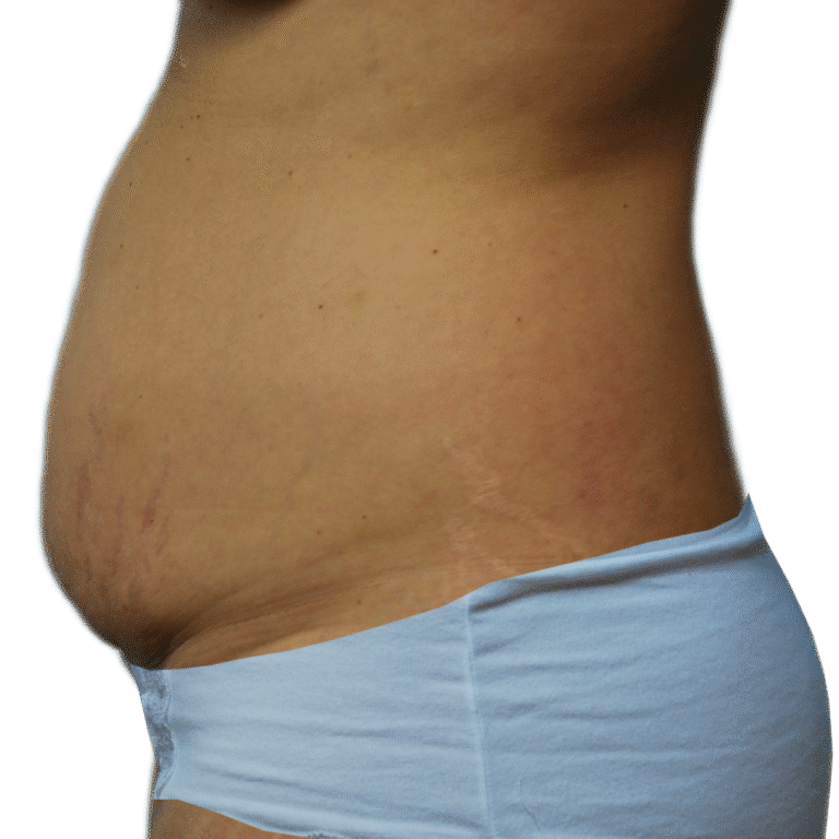 Before Image: Tummy Tuck - left-side