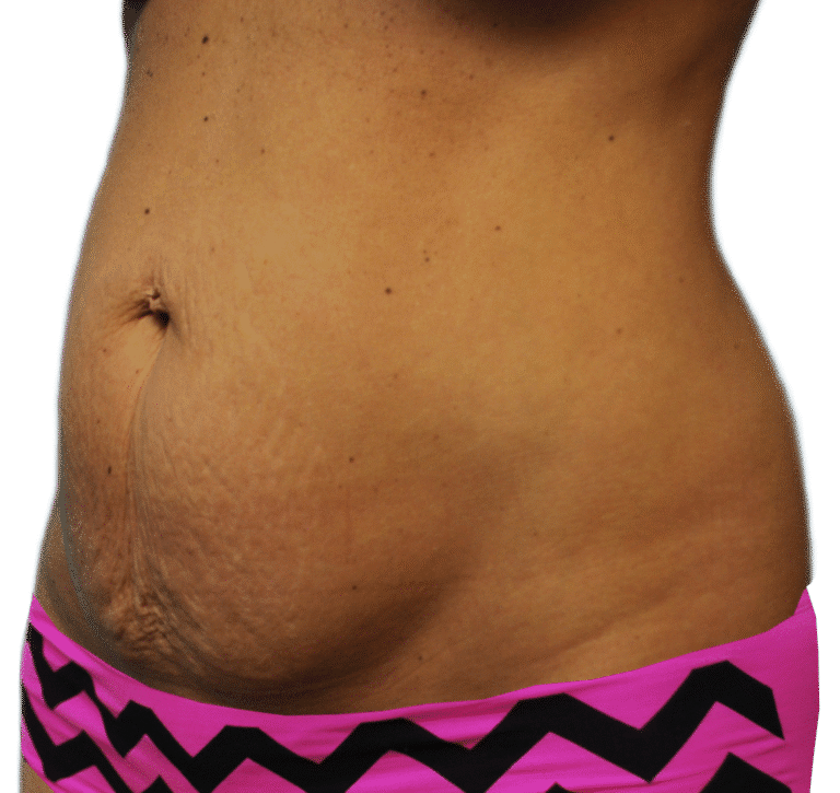 Before Image: Tummy Tuck - left-front-oblique