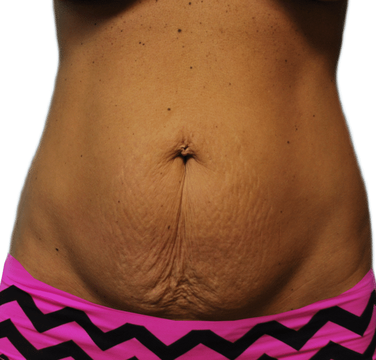 Before Image: Tummy Tuck - front