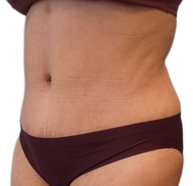 After Image: Tummy Tuck - left-front-oblique